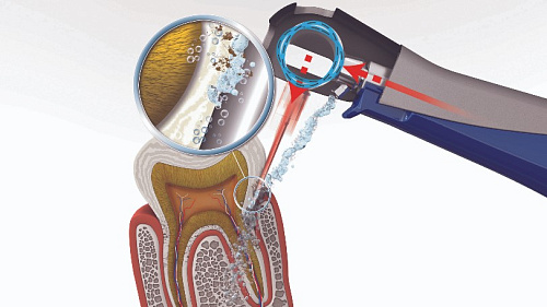 Durr Dental Vector Paro handpiece – наконечник в сборе с кольцом и накладками для аппарата Vector Paro