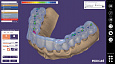 Exocad Bite splint module - модуль шинирования зубов